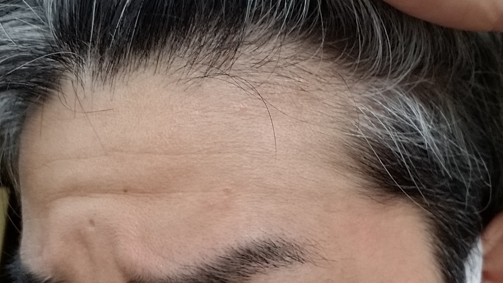 AGA治療はいつから始めれば効果的に薄毛改善できるのか？