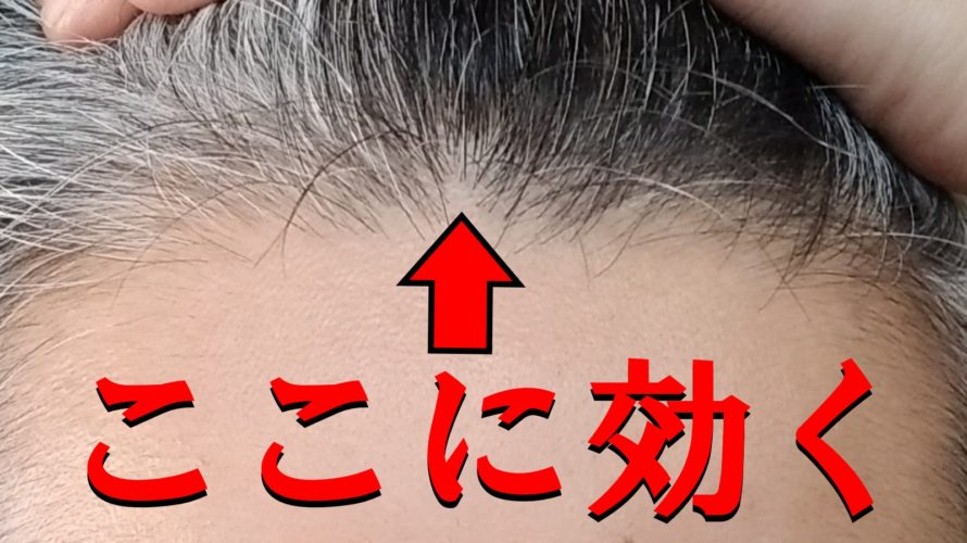 【強力】デュタステリドに切り替えて生え際の薄毛を克服できるのか検証【AGA治療薬】